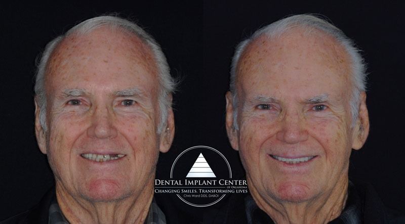 Dental Implant Center of Oklahoma - Before and After