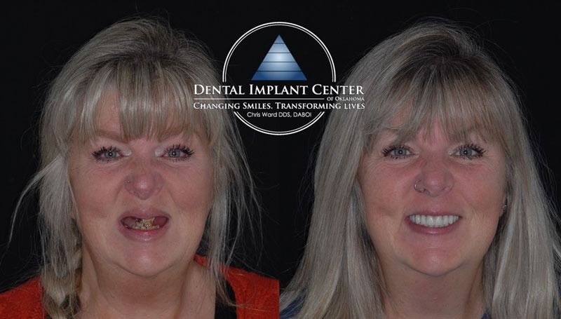 Dental Implant Center of Oklahoma - Before and After