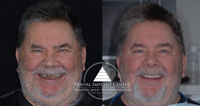 Dental Implant Center of Oklahoma - Before and After