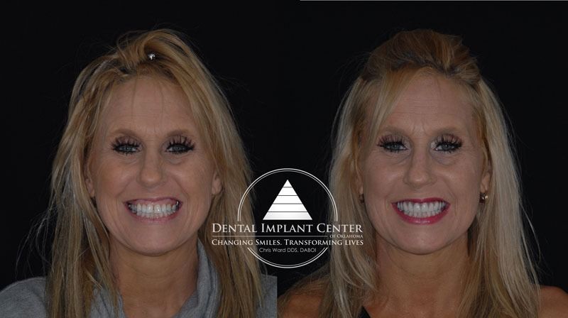 Dental Implant Center of Oklahoma - Before and After