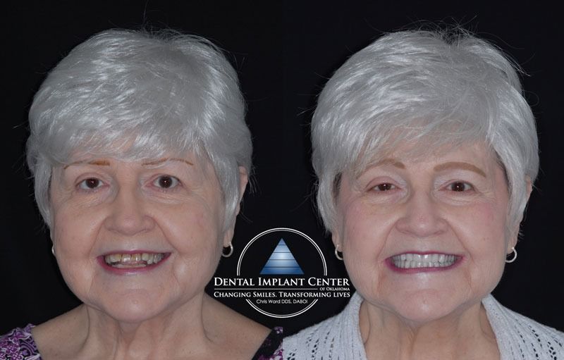 Dental Implant Center of Oklahoma - Before and After
