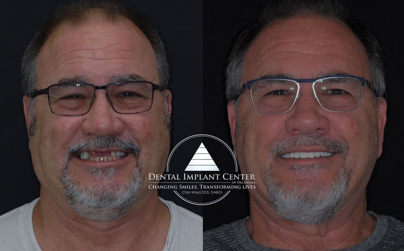 Dental Implant Center of Oklahoma - Before and After