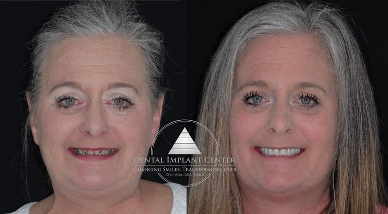 Dental Implant Center of Oklahoma - Before and After