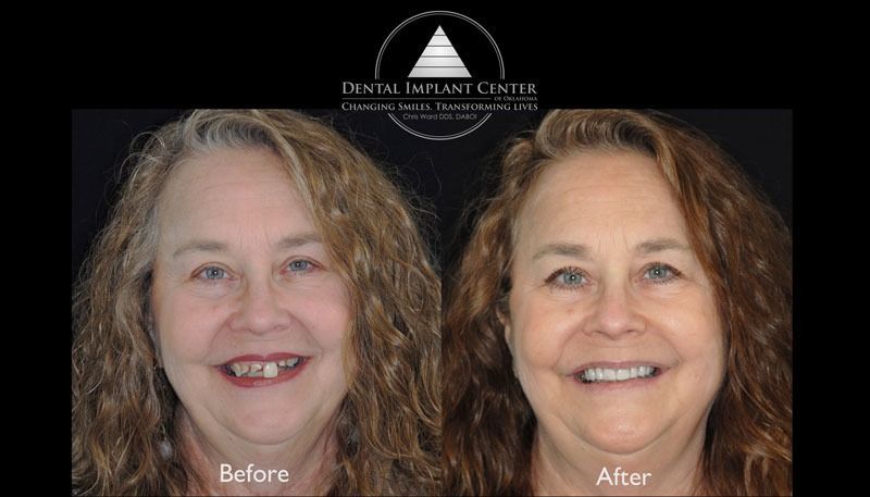 Dental Implant Center of Oklahoma - Before and After