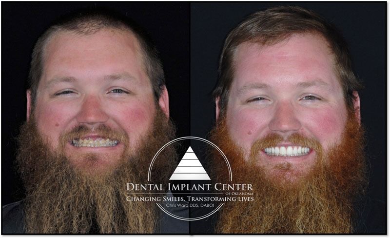 Dental Implant Center of Oklahoma - Before and After