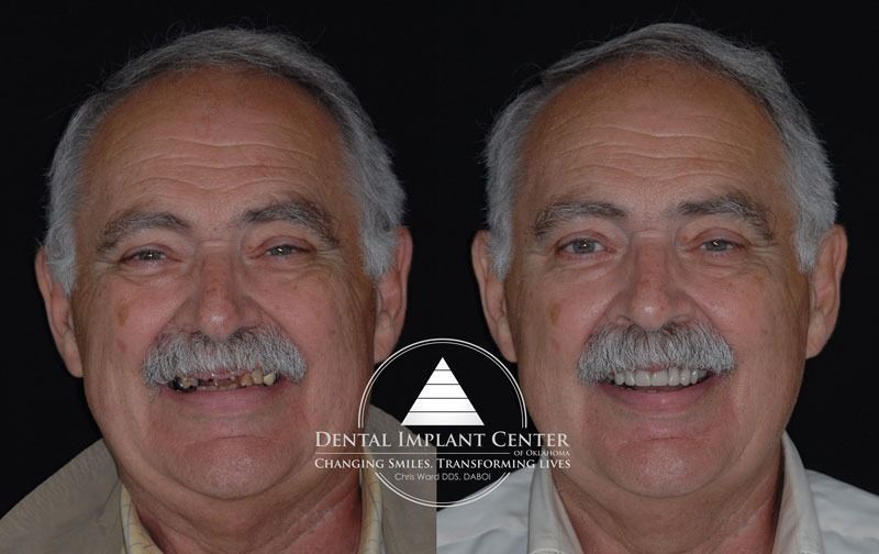Dental Implant Center of Oklahoma - Before and After