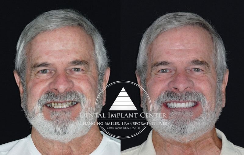 Dental Implant Center of Oklahoma - Before and After