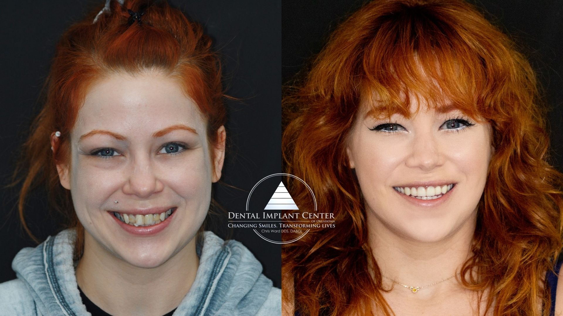 Dental Implant Center of Oklahoma - Before and After