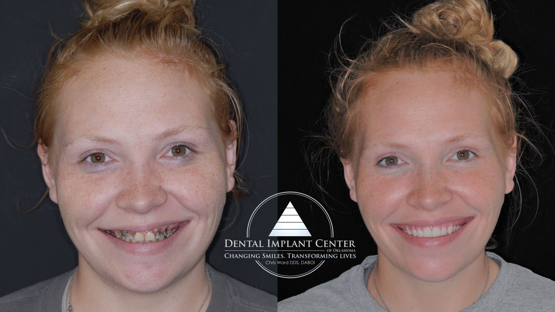 Dental Implant Center of Oklahoma - Before and After
