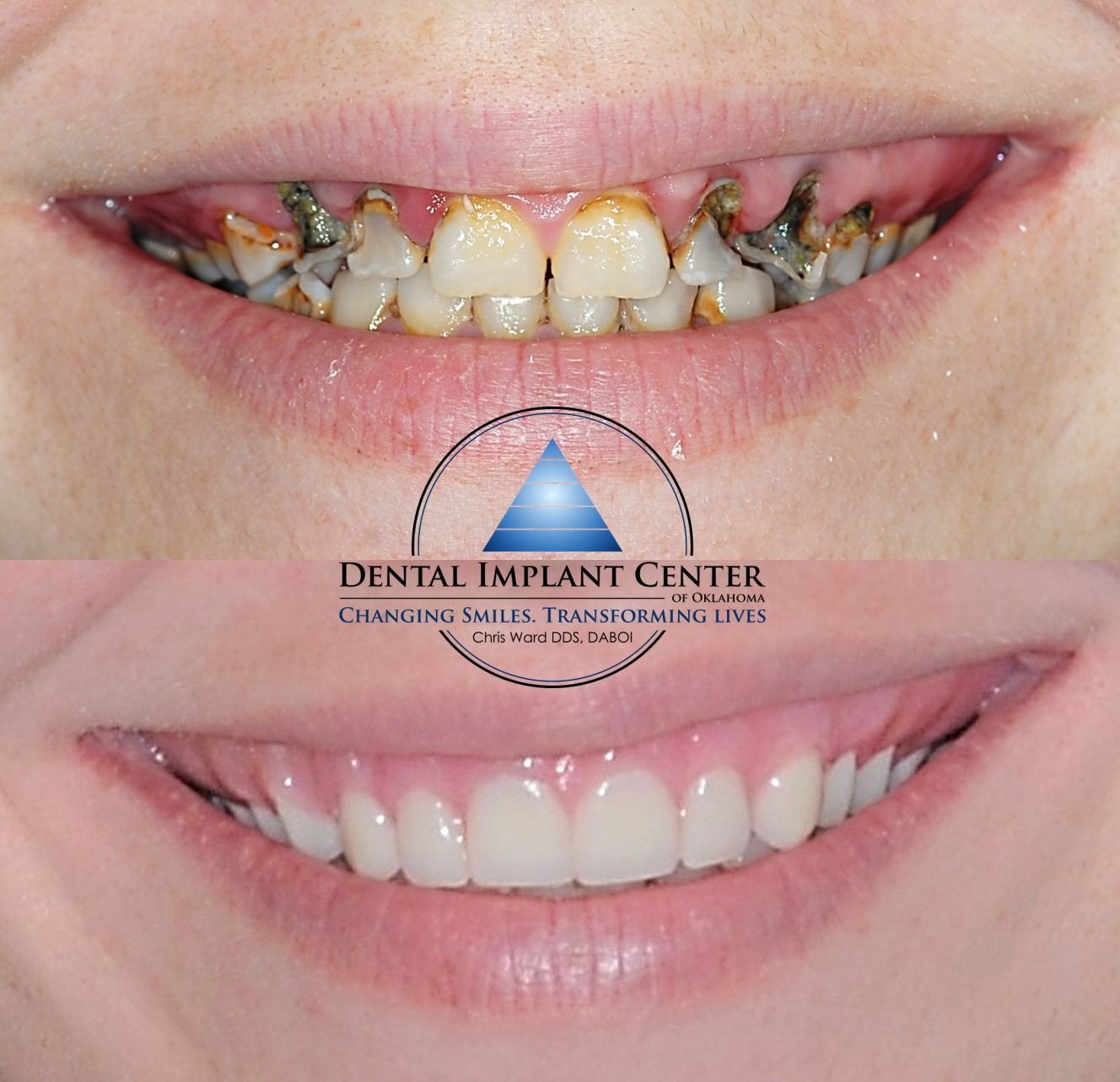 Dental Implant Center of Oklahoma - Before and After