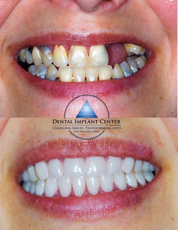 Dental Implant Center of Oklahoma - Before and After