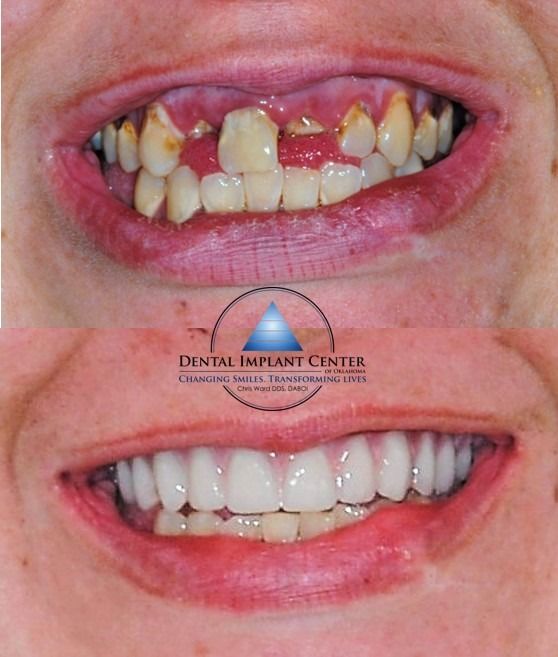 Dental Implant Center of Oklahoma - Before and After