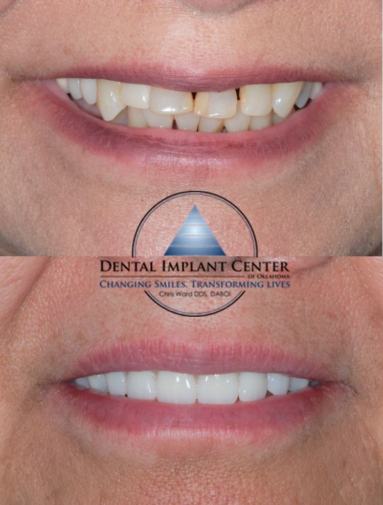 Dental Implant Center of Oklahoma - Before and After