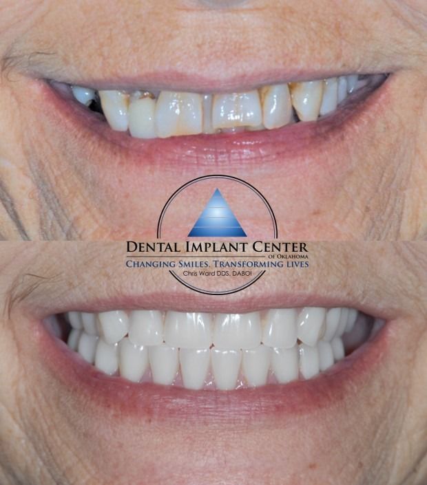 Dental Implant Center of Oklahoma - Before and After