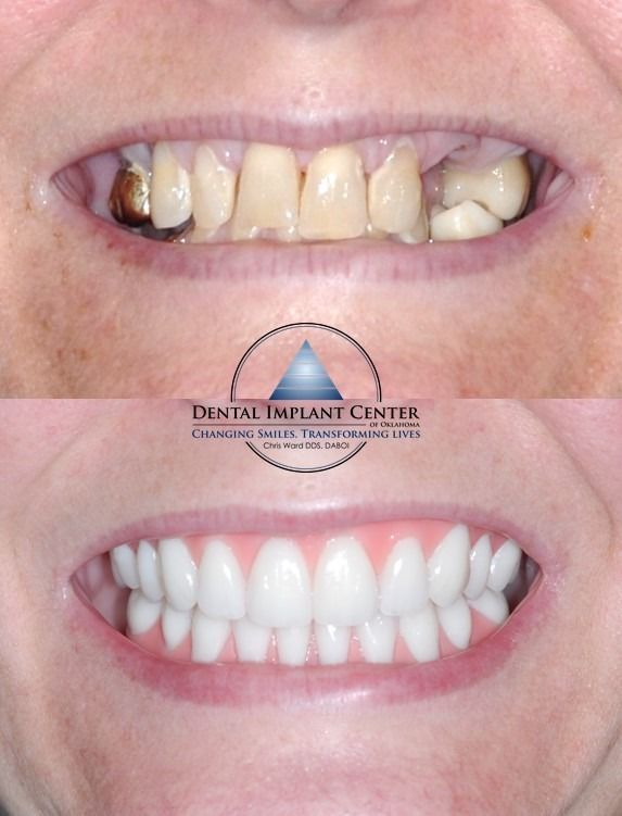 Dental Implant Center of Oklahoma - Before and After