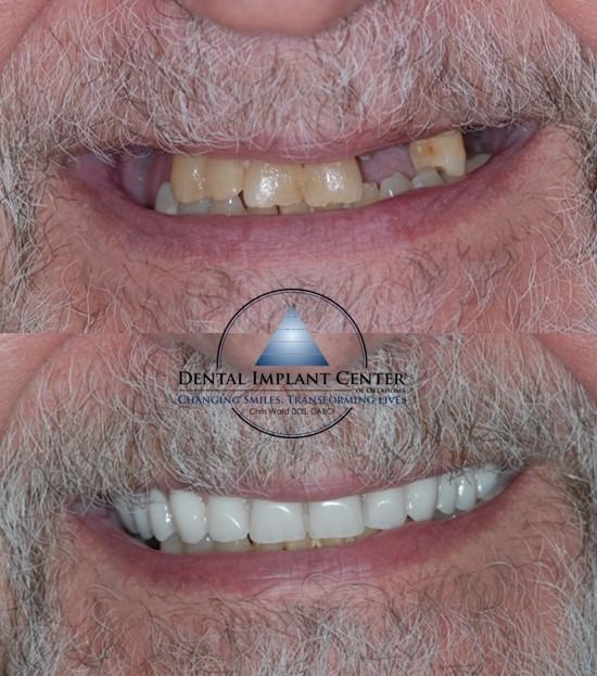 Dental Implant Center of Oklahoma - Before and After