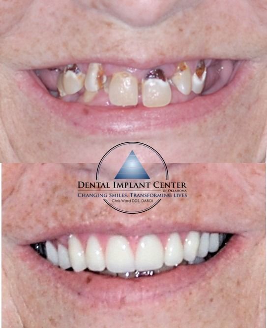 Dental Implant Center of Oklahoma - Before and After