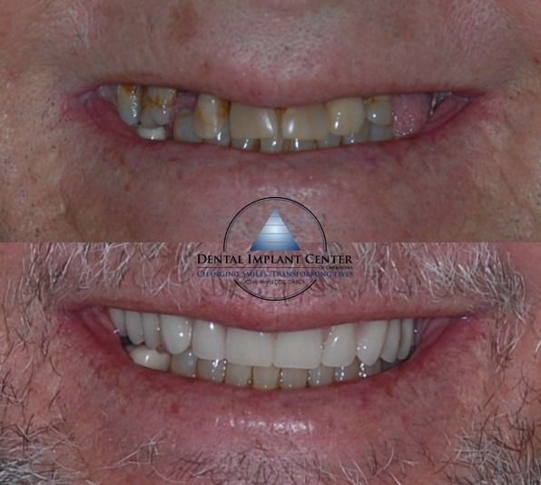 Dental Implant Center of Oklahoma - Before and After