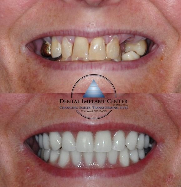 Dental Implant Center of Oklahoma - Before and After