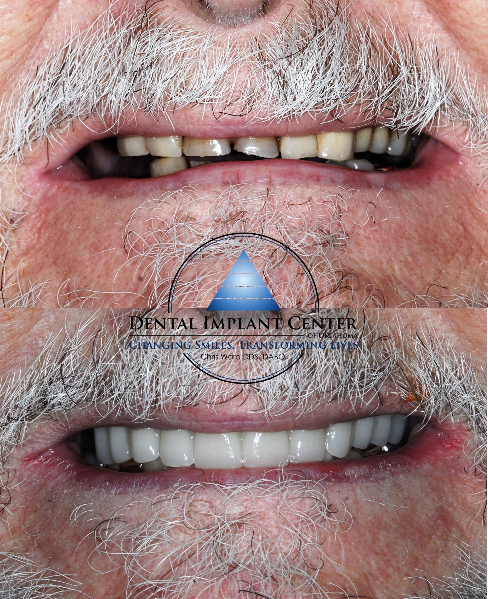 Dental Implant Center of Oklahoma - Before and After