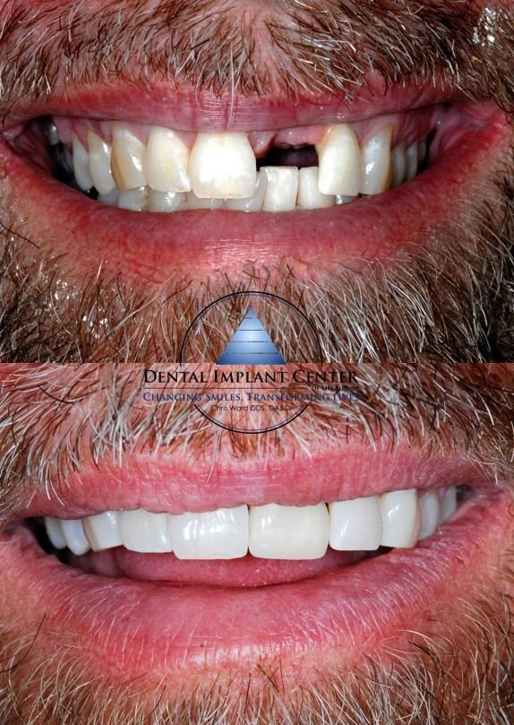 Dental Implant Center of Oklahoma - Before and After