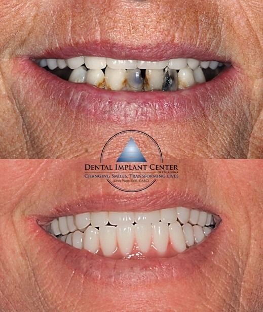Dental Implant Center of Oklahoma - Before and After