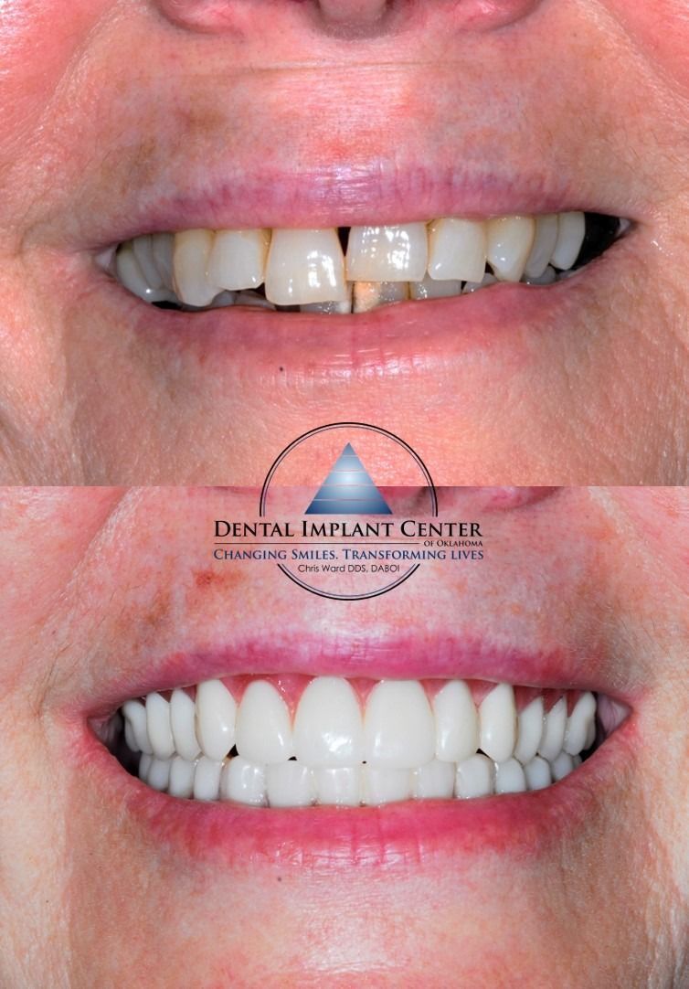 Dental Implant Center of Oklahoma - Before and After