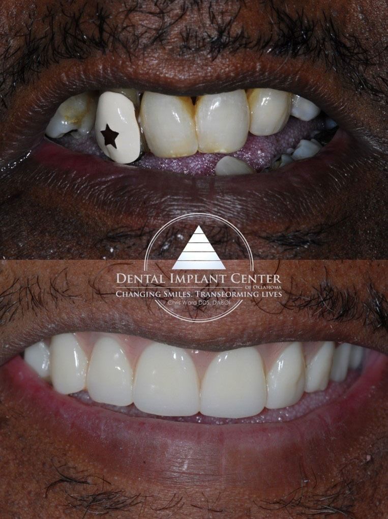 Dental Implant Center of Oklahoma - Before and After