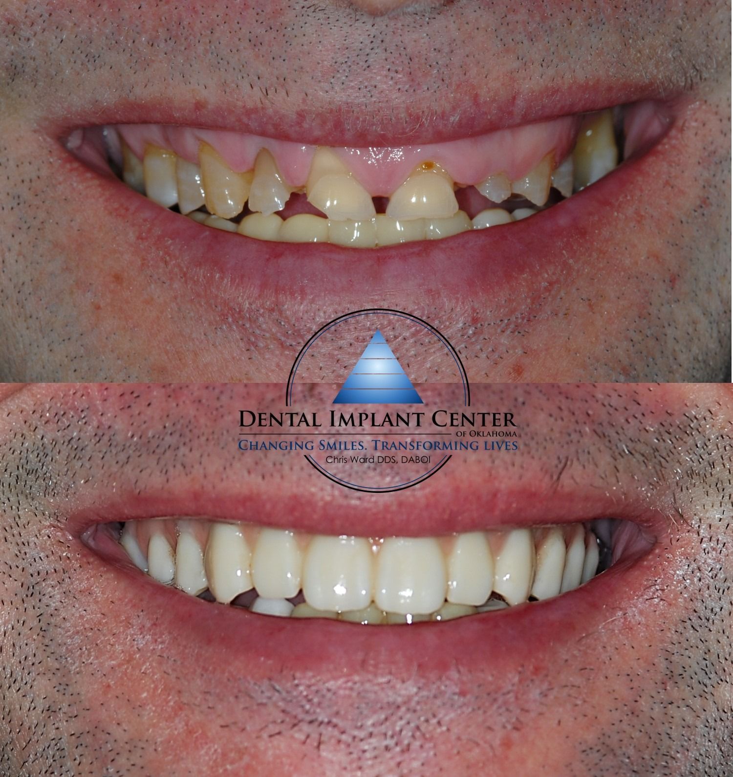 Dental Implant Center of Oklahoma - Before and After