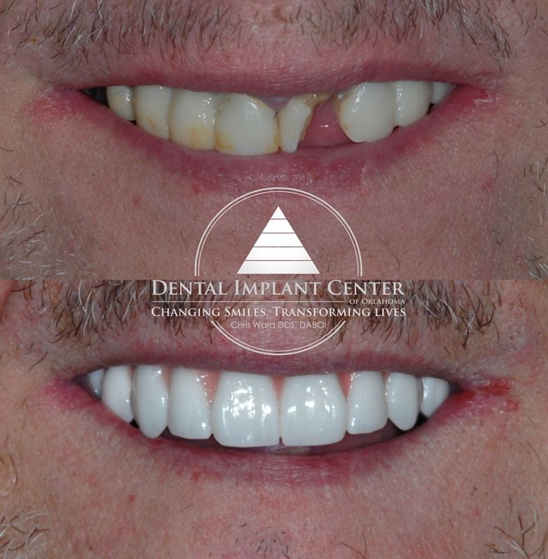 Dental Implant Center of Oklahoma - Before and After