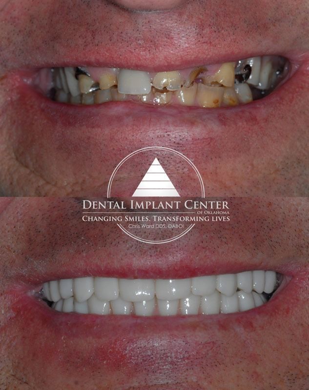 Dental Implant Center of Oklahoma - Before and After