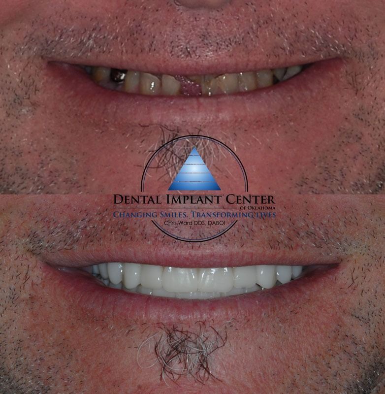 Dental Implant Center of Oklahoma - Before and After