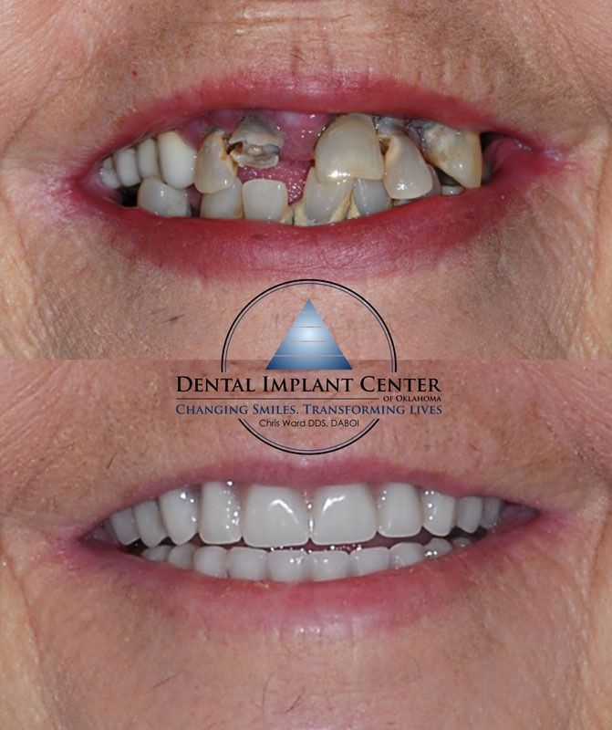 Dental Implant Center of Oklahoma - Before and After