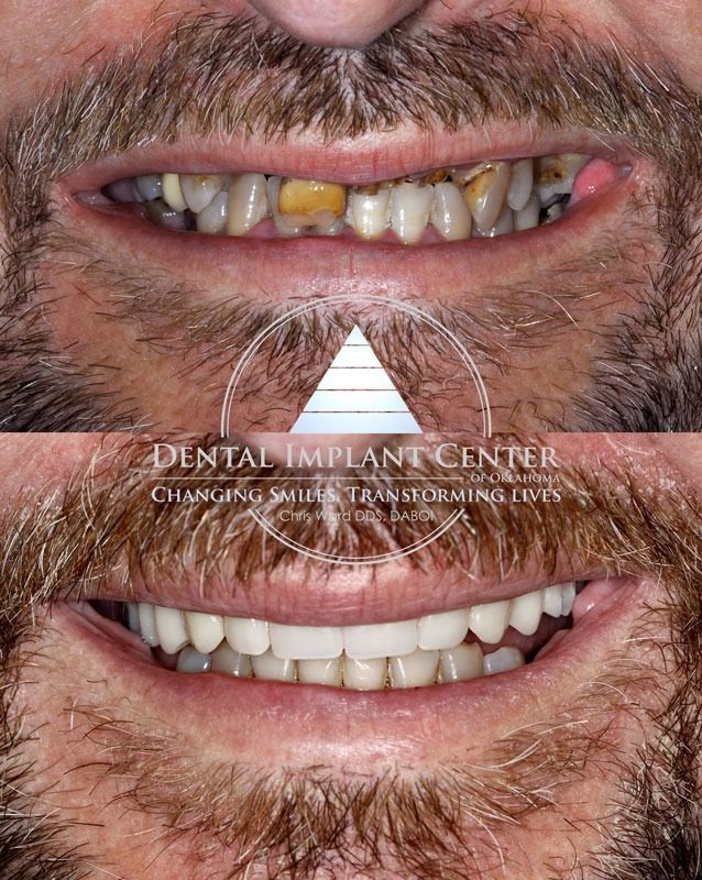Dental Implant Center of Oklahoma - Before and After