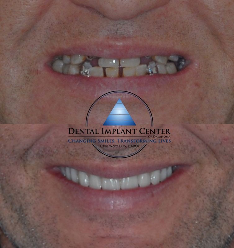Dental Implant Center of Oklahoma - Before and After