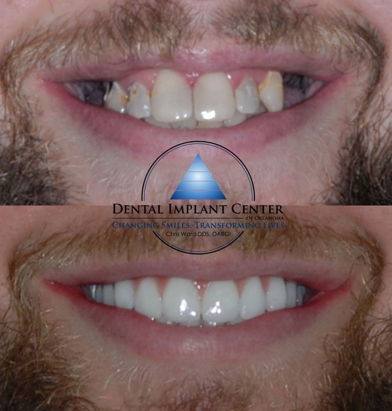 Dental Implant Center of Oklahoma - Before and After