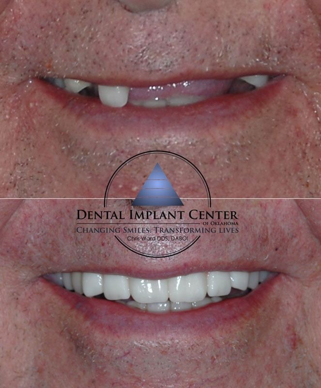 Dental Implant Center of Oklahoma - Before and After