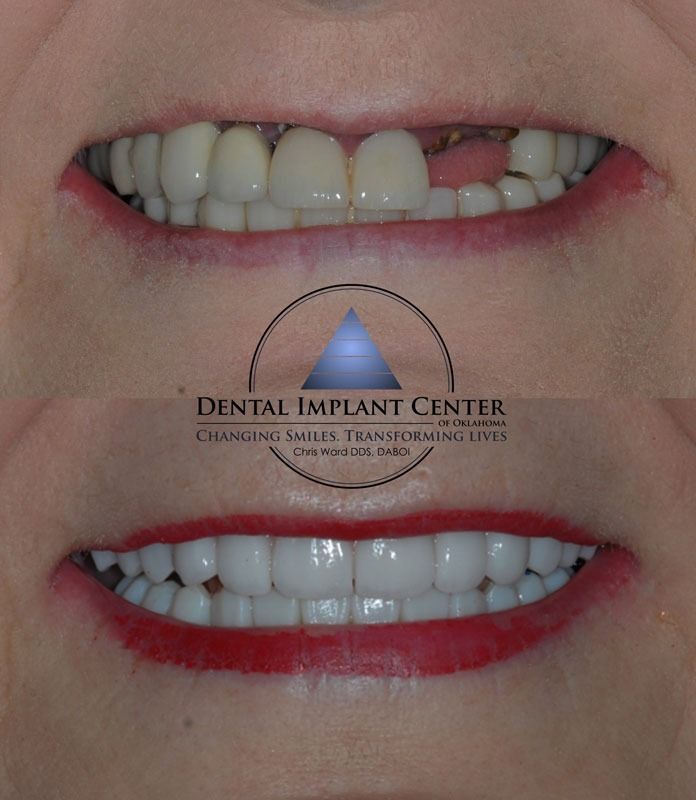 Dental Implant Center of Oklahoma - Before and After