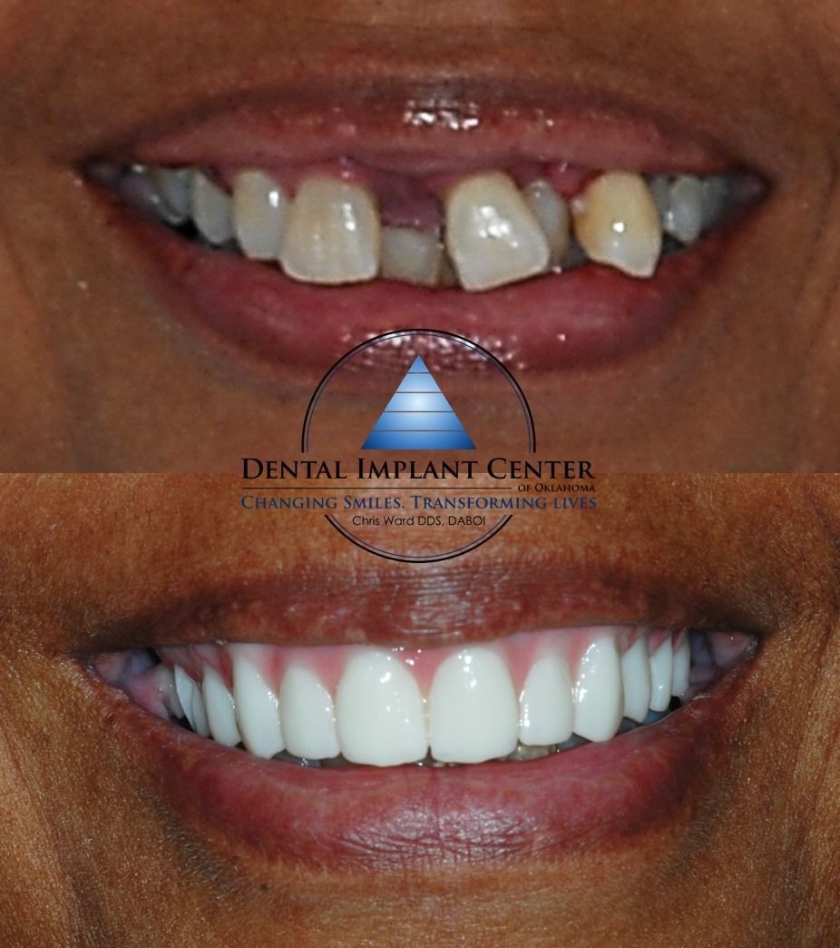 Dental Implant Center of Oklahoma - Before and After