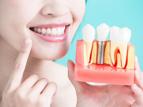 Woman smiling, pointing to a dental model showing a tooth implant, blue background.