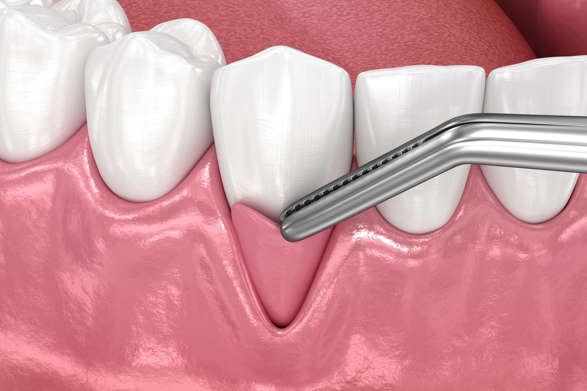 Receding Gums? We Offer Gum Graft Treatment in Tulsa
