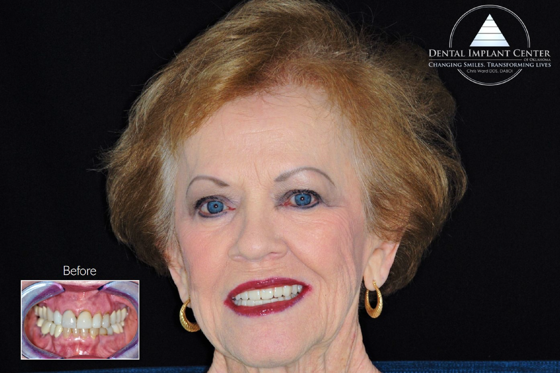 Dental Implant Center of Oklahoma - Before and After