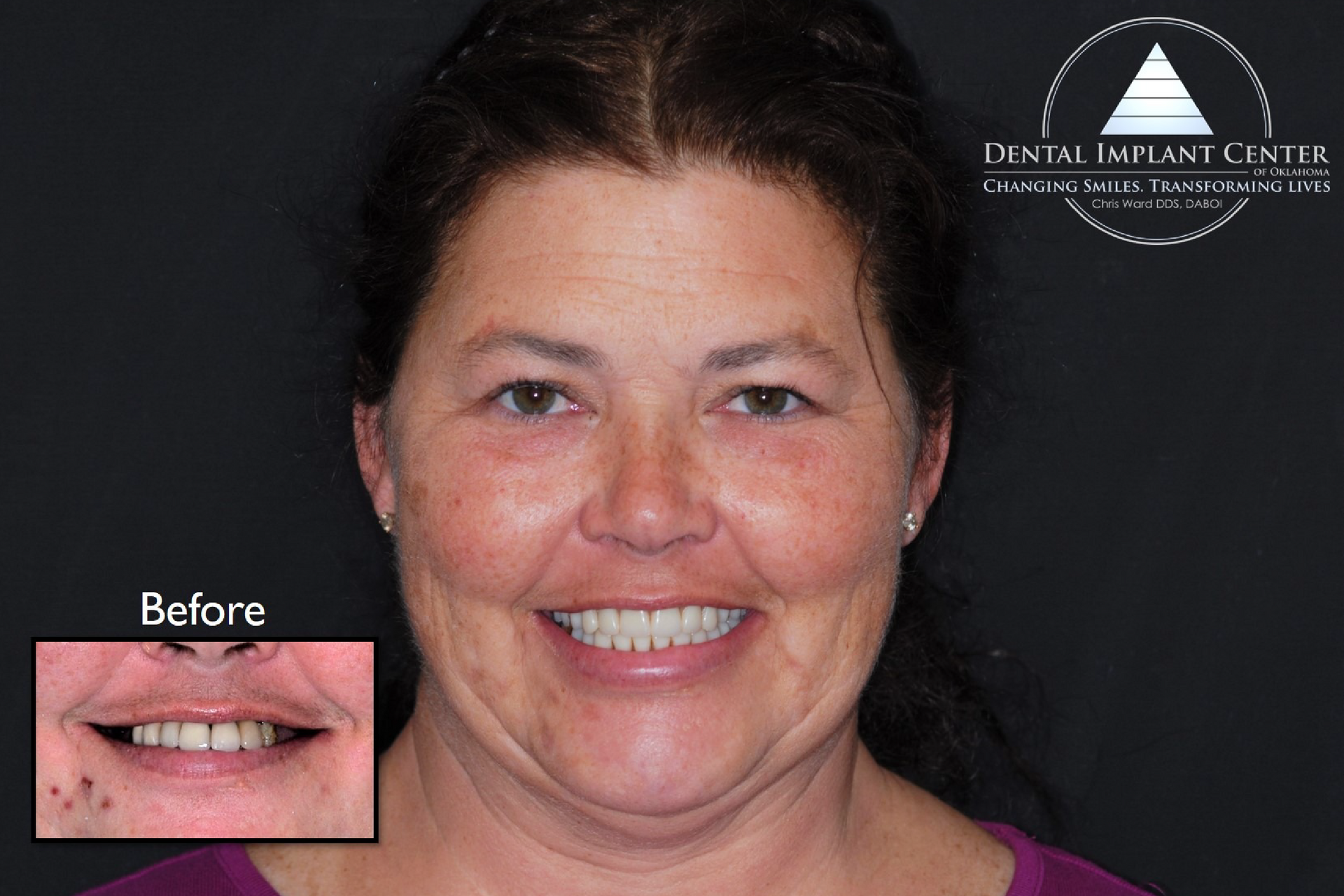 Dental Implant Center of Oklahoma - Before and After