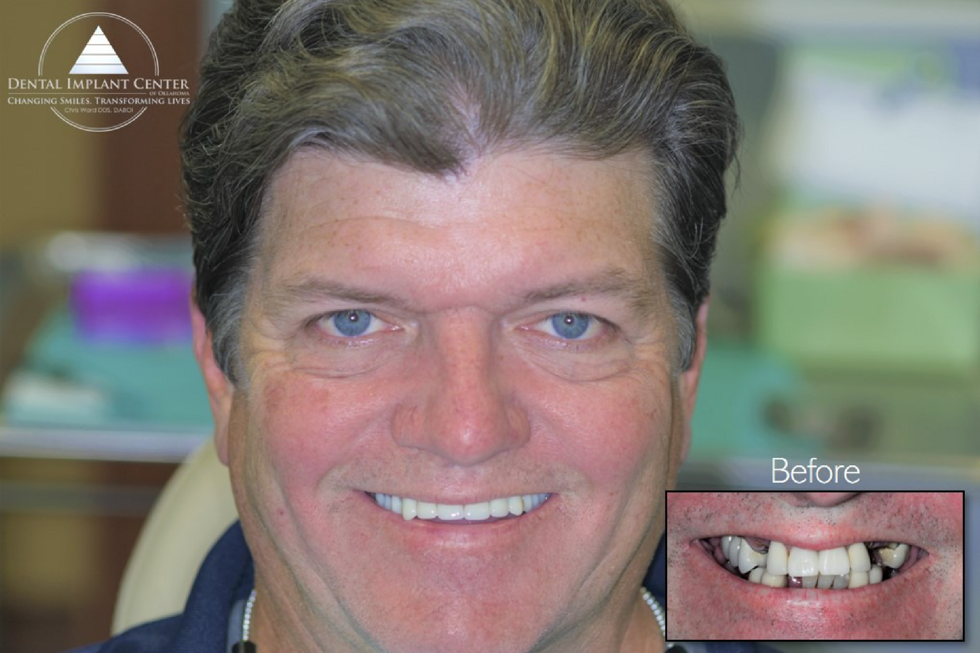 Dental Implant Center of Oklahoma - Before and After