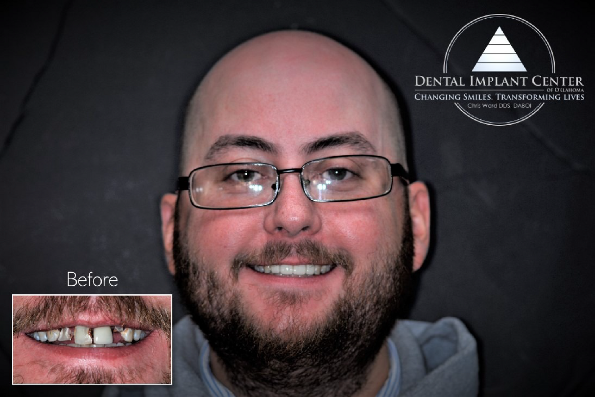Dental Implant Center of Oklahoma - Before and After