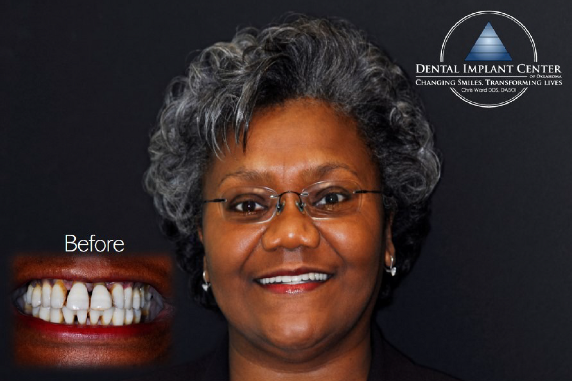 Dental Implant Center of Oklahoma - Before and After
