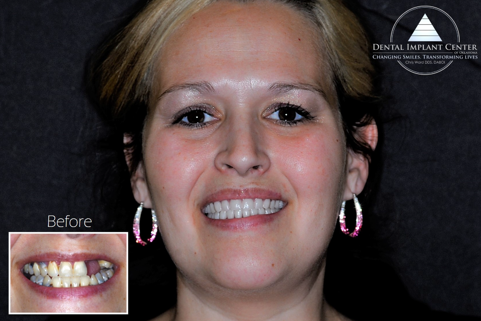 Dental Implant Center of Oklahoma - Before and After