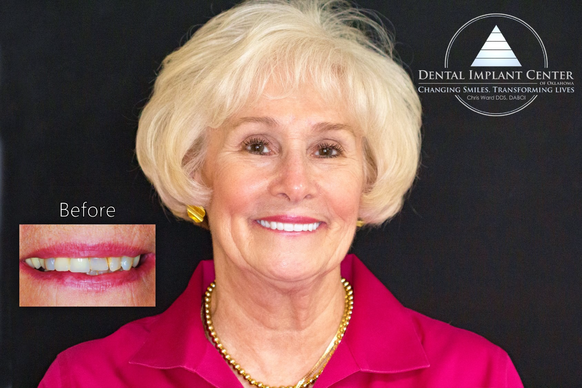 Dental Implant Center of Oklahoma - Before and After