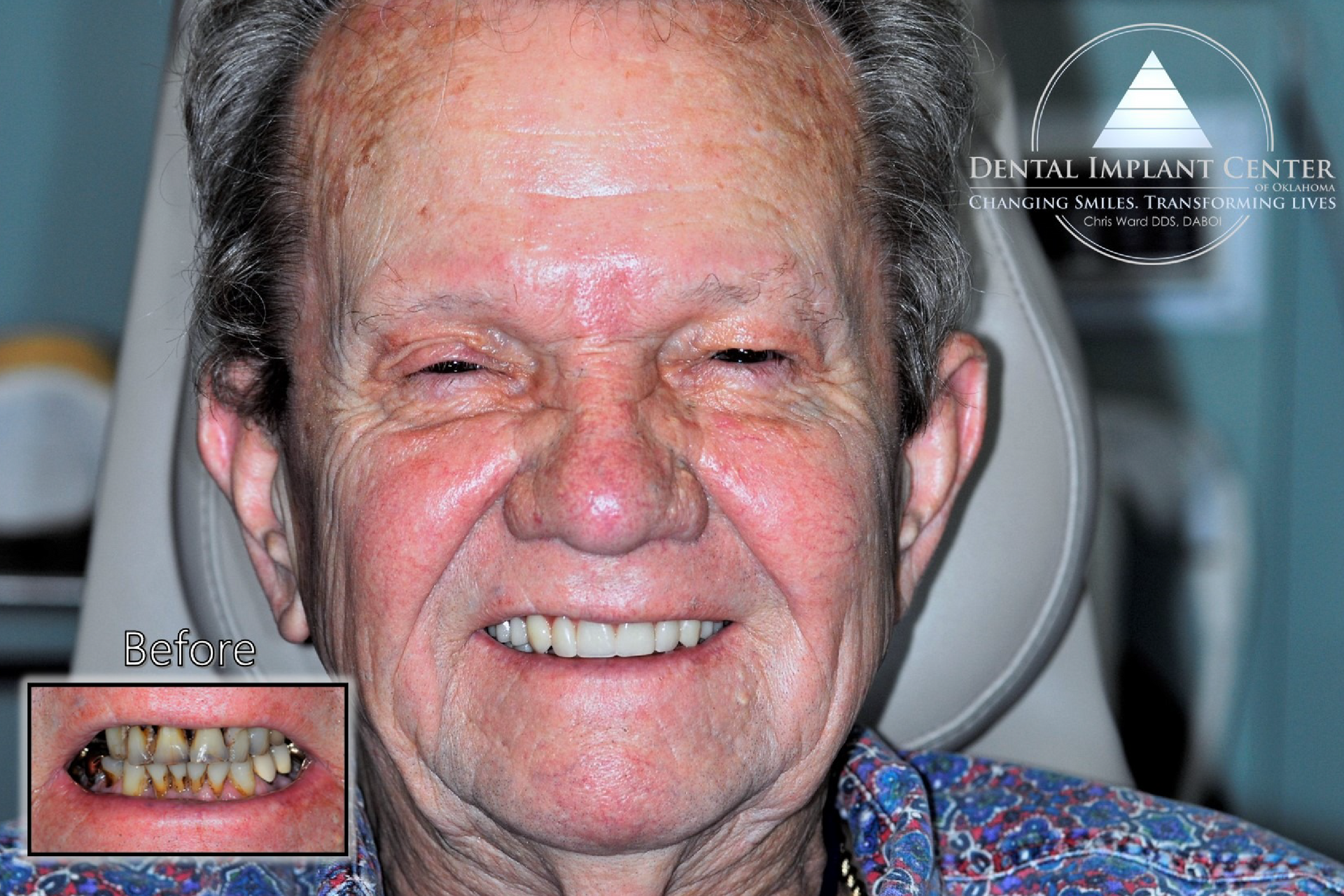 Dental Implant Center of Oklahoma - Before and After
