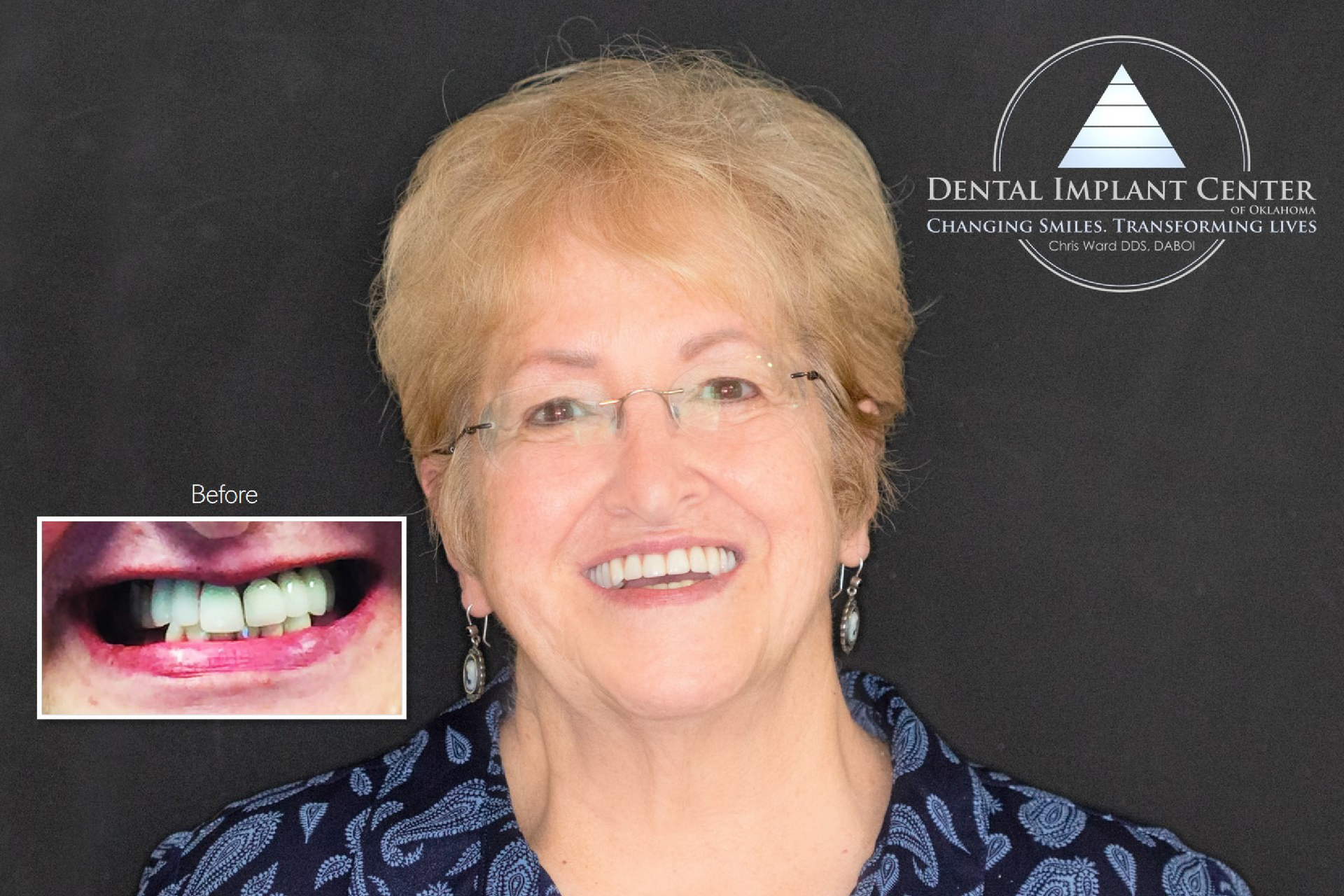 Dental Implant Center of Oklahoma - Before and After